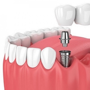 Revolutionizing Smiles: The Transformative Journey of Dental Implants